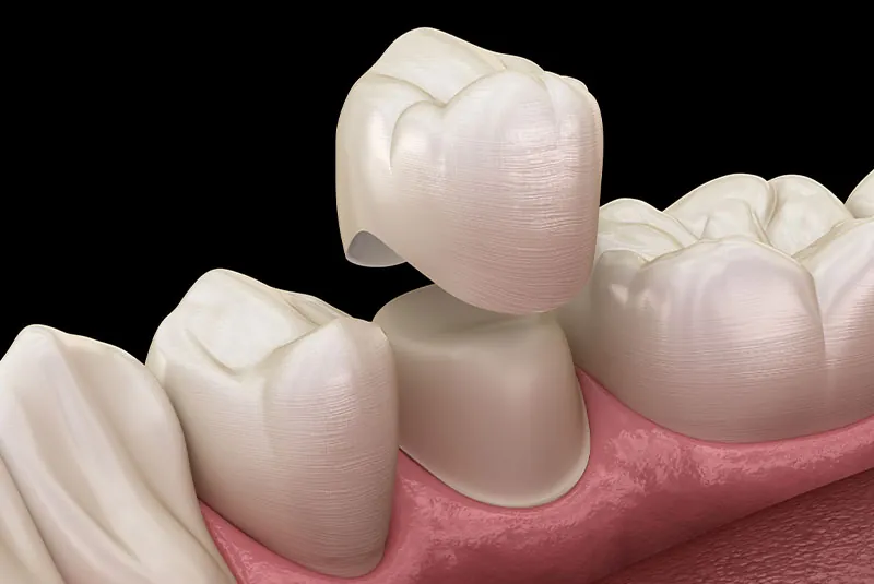 dental crowns