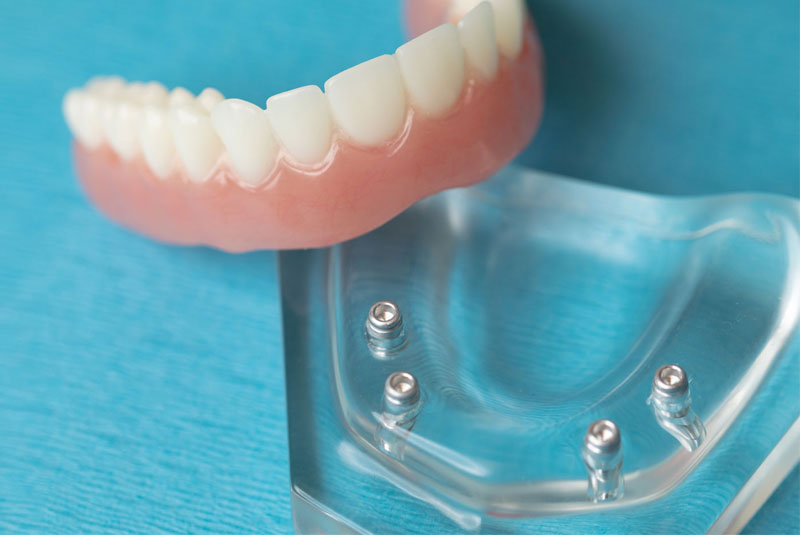 implant supported denture