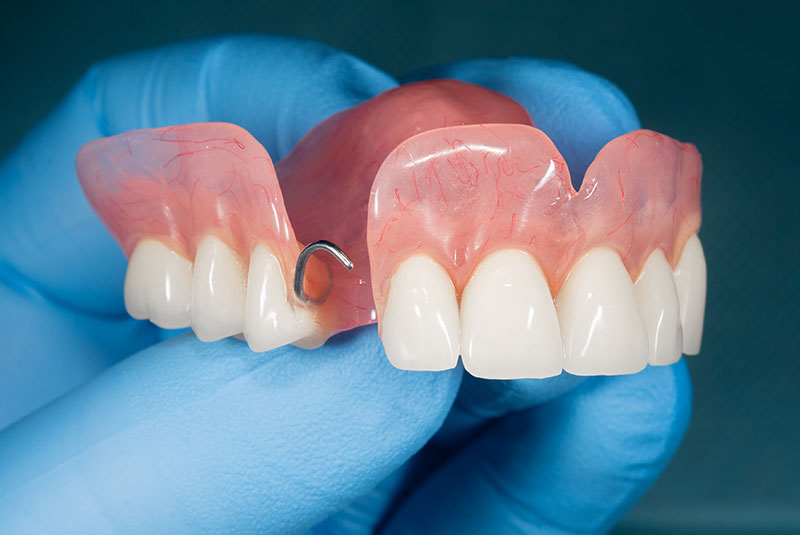 partial denture metal