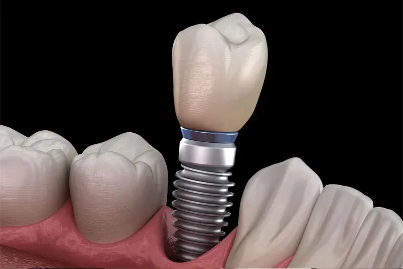 Dental implant positioned in a jawbone with adjacent teeth.